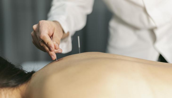 Acupuntura (Foto: Freepik)